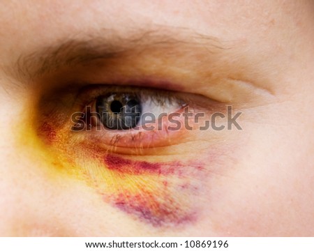 Bruised Eye Stock Photos, Images, & Pictures | Shutterstock
