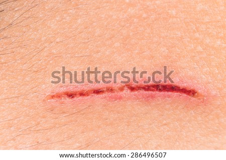 scar on human skin stock photo 97015703 scar on human skin stock photo 97015703 scar on human skin stock photo 97015703 scar on human skin stock photo 97015703