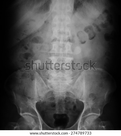 Xray Image Child Swallowed Coins Medical Stock Photo 342401210