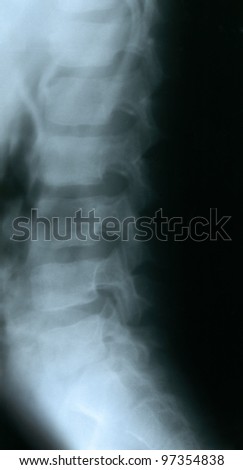 L5 S1 Lumbar Spot Xray Stock Photo 3679996 - Shutterstock