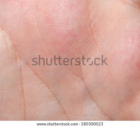 pictures of pimple on human skin macro k9188528 search stock photos images print pimple on skin closeup stock photo 137260643 pictures of pimple on human skin macro k9188528 search stock photos images print pimple on skin closeup stock photo 137260643