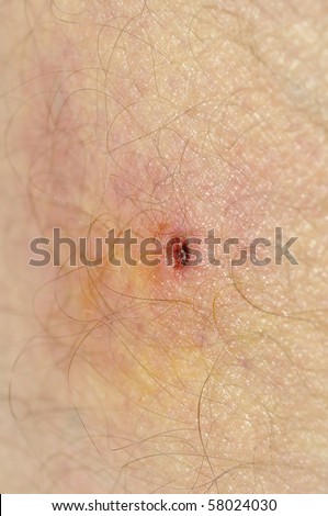 Tick Bite Images & Stock Pictures. Royalty Free Tick Bite ...