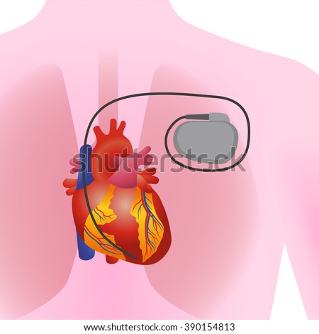 cardiac pacemaker business Pacemaker - an implanted electronic device that takes over the function of the natural cardiac pacemaker (in market, business) = pacesetter 2 pacemaker. cardiac pacemaker business Pacemaker - an implanted electronic device that takes over the function of the natural cardiac pacemaker (in market, business) = pacesetter 2 pacemaker.