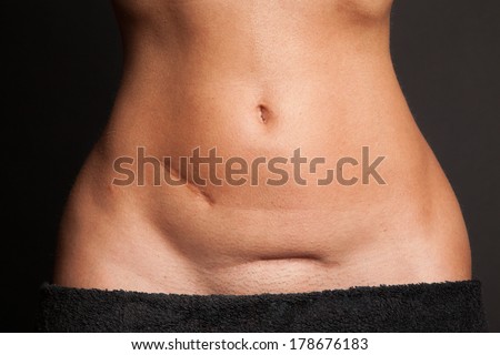 Opinion pictures of naked girls with scars on belly that Are not pictures of naked girls with scars on belly too seemed