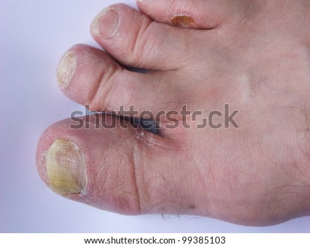 Athletes Foottoenail Mycosis Stock Photo 99385100 - Shutterstock