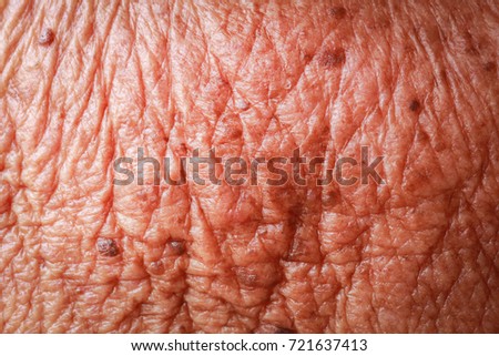 macro eczema on grip skin stock photo 7891171 macro eczema on grip skin stock photo 7891171 macro eczema on grip skin stock photo 7891171 macro eczema on grip skin stock photo 7891171