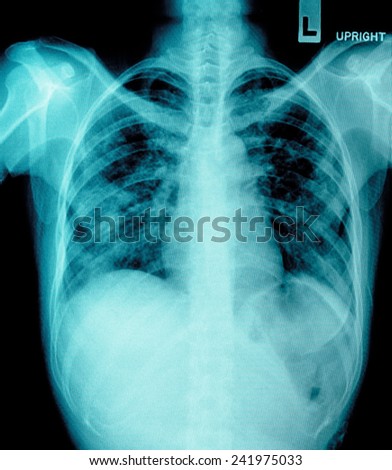 Atelectasis Lung Icd 10 Code image information