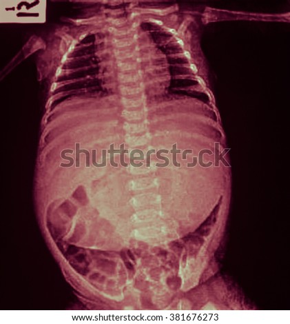 What is abdominal distension