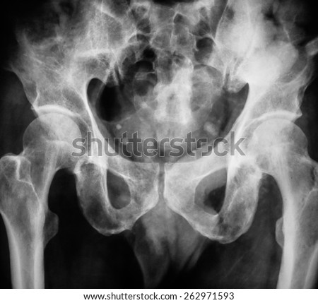 Xray Picture Showing Female Pelvis Hip Stock Photo 23216185 - Shutterstock