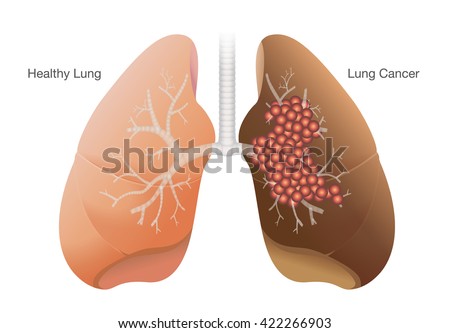 Healthy Lung Images