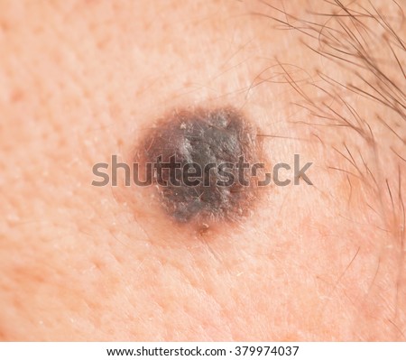 scar on human skin stock photo 209040517 scar on human skin stock photo 209040517 scar on human skin stock photo 209040517 scar on human skin stock photo 209040517