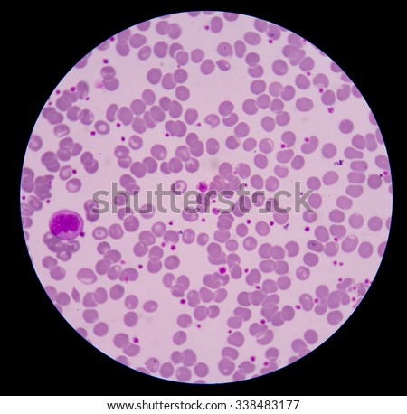 Target Cell Peripheral Blood Smear Stock Photo 593126135 - Shutterstock