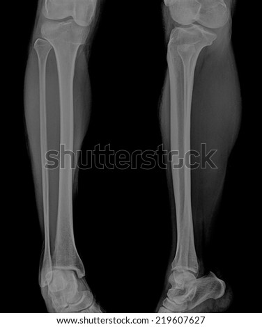 Forearm Xray Stock Photo 2663940 - Shutterstock