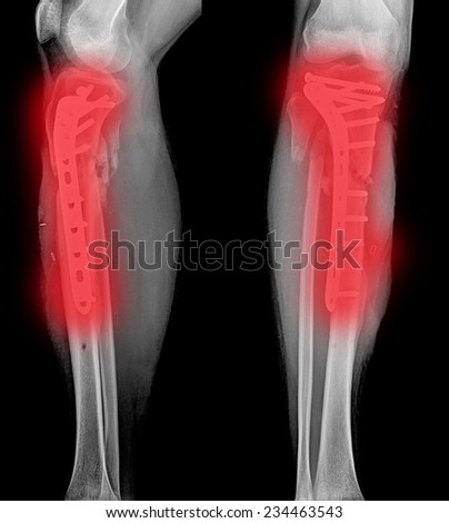 Human Leg Joints Muscles 3d Stock Illustration 408602722 ...