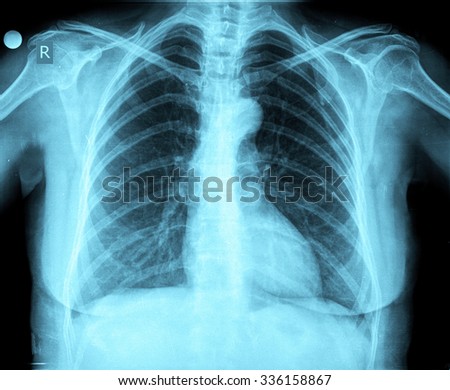 Chest Xray Lungs Young Girl Diagnosis Stock Photo 66099106 - Shutterstock