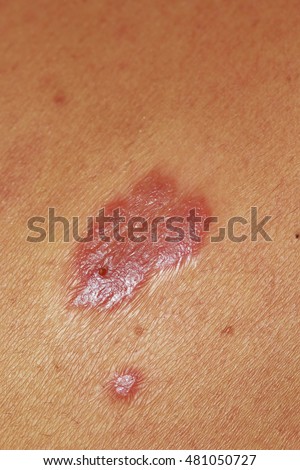 macro texture of burns on human skin back stock photo 415678729 freckles on skin stock photo 563236840 macro texture of burns on human skin back stock photo 415678729 freckles on skin stock photo 563236840
