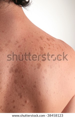 Back Spot Stock Photo 38458117 - Shutterstock