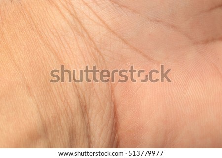 burn scar stock photo 57476164 burn scar stock photo 57476164 burn scar stock photo 57476164 burn scar stock photo 57476164