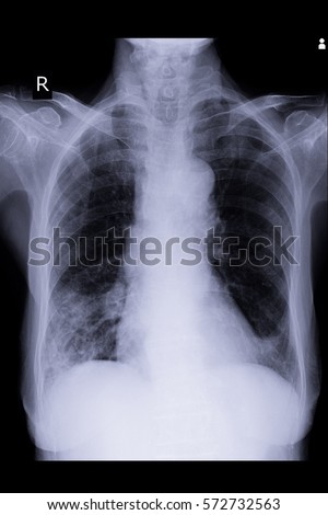 Xray Image Show Infiltration Right Lung Stock Photo 572732521 ...