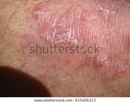 Acne Inversa Hidradenitis Suppurativa Armpit Stock Photo 147990656 ...