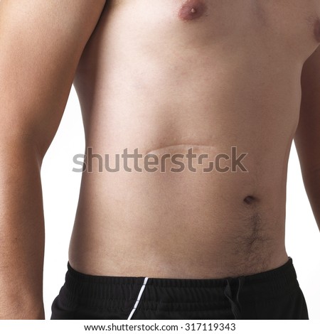 Pictures of naked girls with scars on belly remarkable Pictures of naked girls with scars on belly something