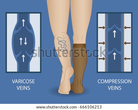 Types of compression socks for women