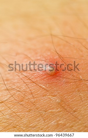 pictures of pimple on human skin macro csp9188528 search stock photos images canker on skin stock photo 143764339 pictures of pimple on human skin macro csp9188528 search stock photos images canker on skin stock photo 143764339