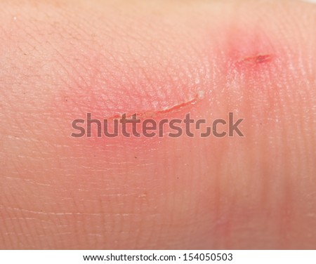 scar on human skin stock photo 121658896 scar on human skin stock photo 209040517 scar on human skin stock photo 121658896 scar on human skin stock photo 209040517