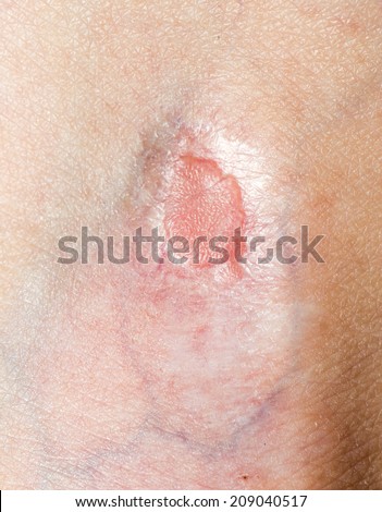 stock photo of scar on the human skin k21774142 search stock photography print pictures scar on human skin stock photo 209040517 stock photo of scar on the human skin k21774142 search stock photography print pictures scar on human skin stock photo 209040517