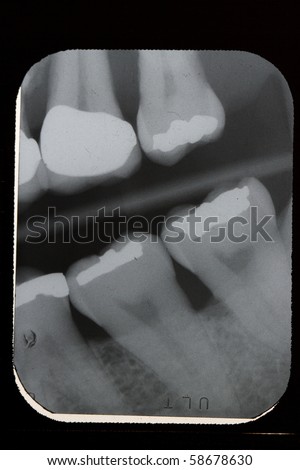 Broken Tooth Lower Left Molar Distolingual Stock Photo 58678609 ...