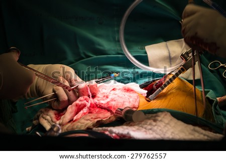 Uterus Tissues Macro During Hysterectomy Surgery Stock 