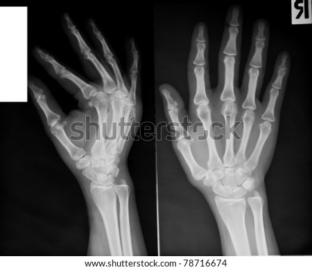 Xray Human Hand Wrist Stock Photo 62282380 - Shutterstock