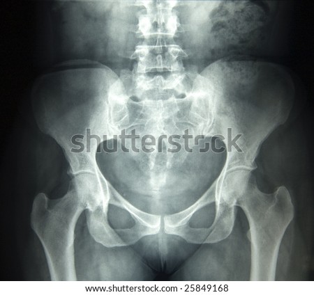 Xray Picture Showing Female Pelvis Stock Photo 36117439 - Shutterstock