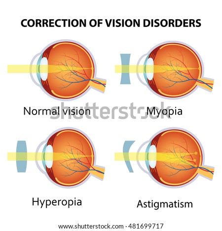 stock vector correction of various eye vision disorders by lens hyperopia myopia and astigmatism 481699717