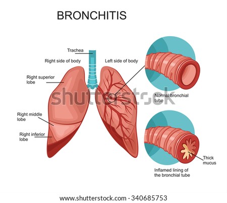 Pulmonary Edema Stock Illustration 117980263 - Shutterstock