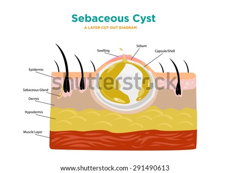 cyst nematodes